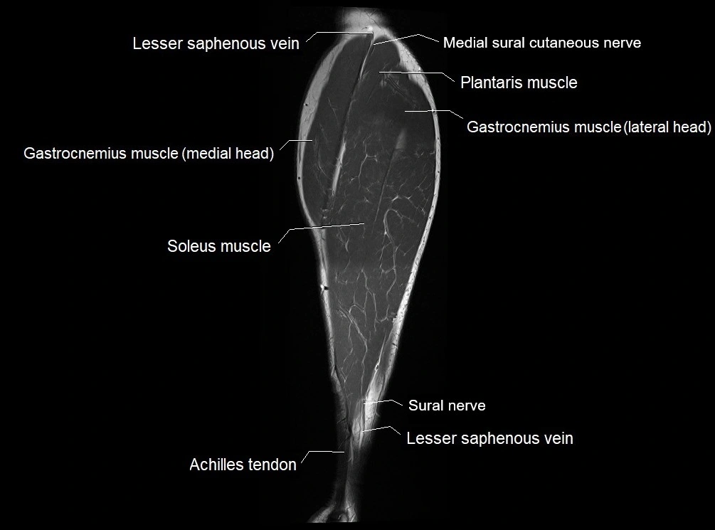 MRI 3T leg (tibia & fibula) labelled coronal cross sectional anatomy image 25.webp